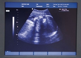 Monitor screen shows an ultrasound